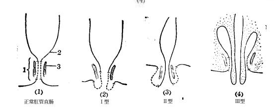 肛管直肠脱垂分几度,直肠脱垂的分度为几度