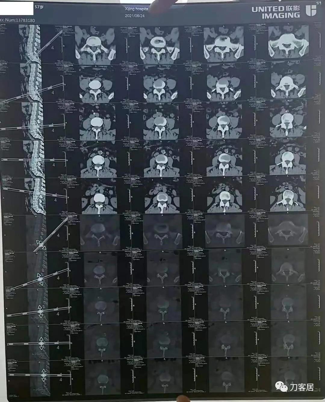 小针刀扎到坐骨神经会瘫痪吗,小针刀会切断坐骨神经吗