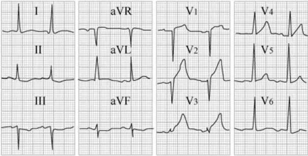 心律失常55分钟讲解,心律失常心电图讲解视频教程全集