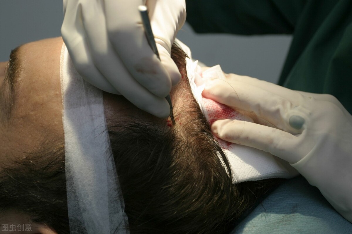 植发后怎么才能长得更好,植发之后和本来的头发有区别吗