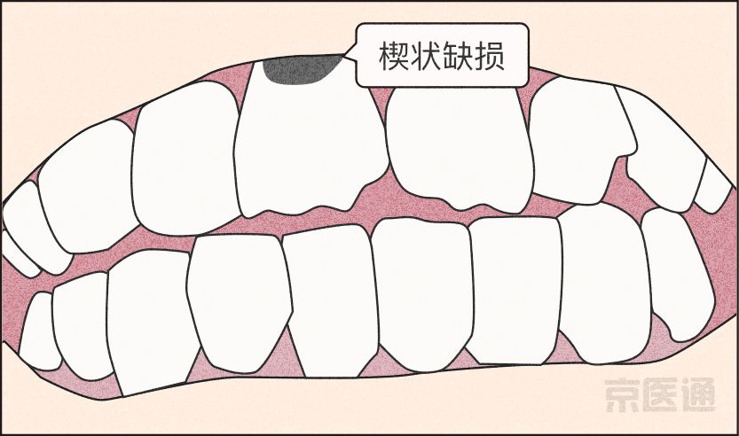 磨牙不好是真的吗,磨牙的危害与注意事项