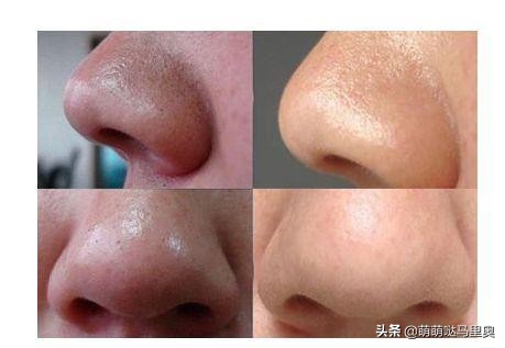 把鼻子里的黑头连根拔起,黑头怎么挤不痛又快