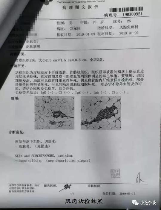 皮肌炎病史,皮肌炎二十年没有治疗