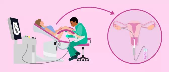 35公分的针“扎进去”取卵后保养卵巢很需要