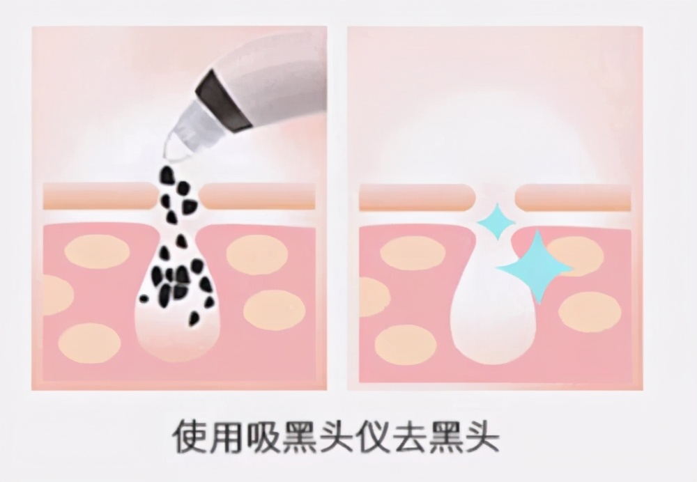 inface黑头仪好用吗,拒绝油腻大叔