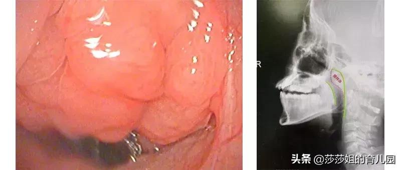 张嘴呼吸一定是腺样体肥大吗,张口呼吸一定会腺样体面容吗