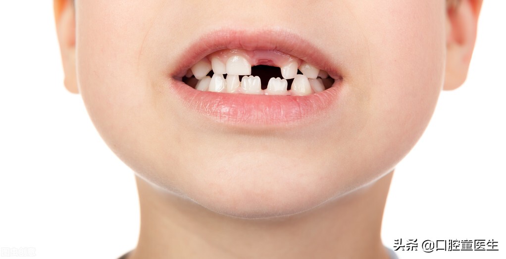 牙齿固定修复有哪几种,固定修复牙齿什么意思