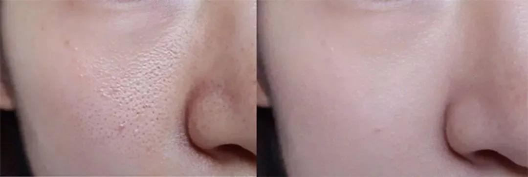 油皮控油的最好方法,混油皮夏季控油保湿