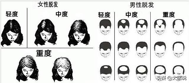 中医治疗雄性激素脱发,中医怎么看脂溢性脱发