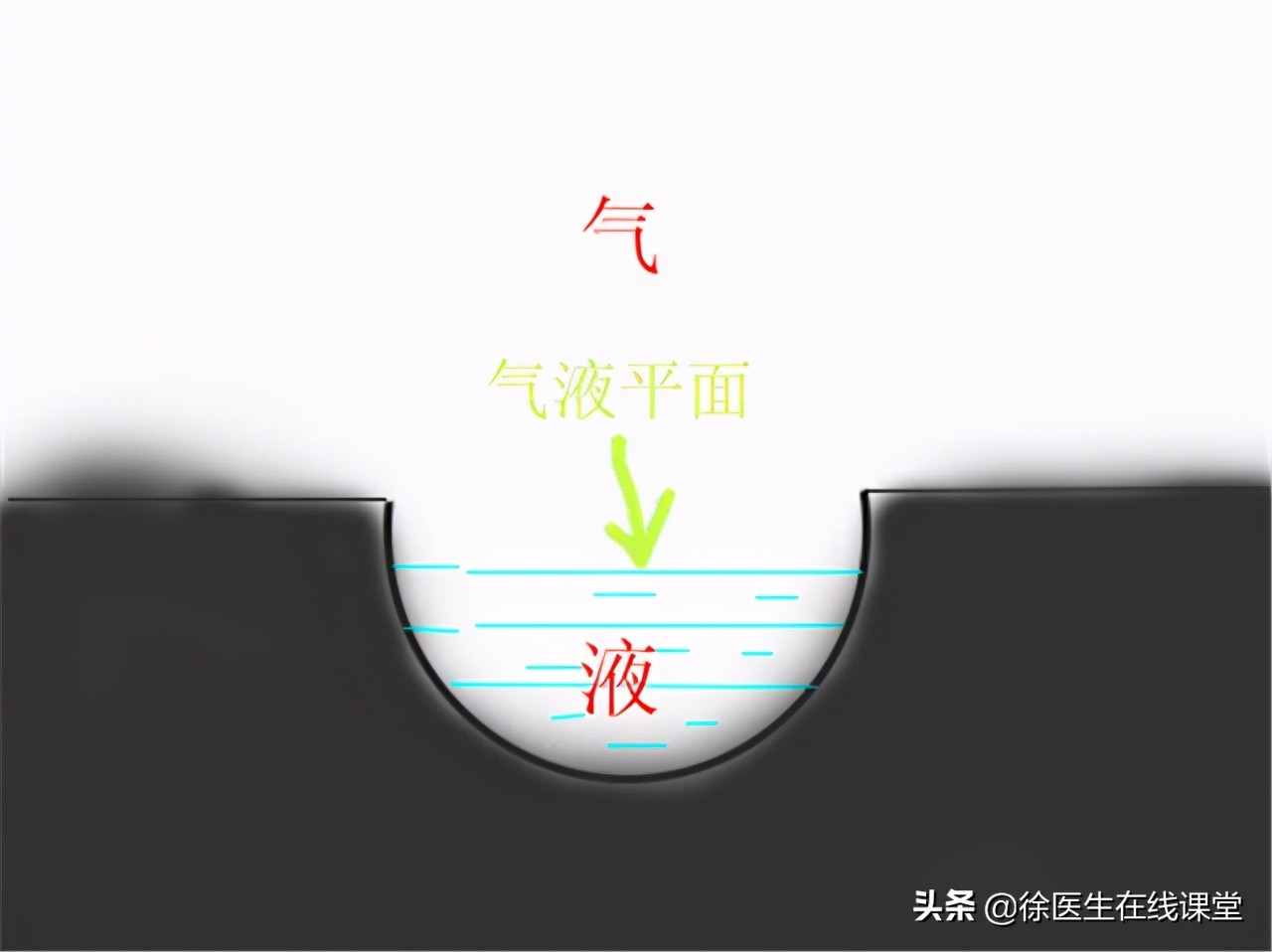 肺脓肿是局限性化脓性炎吗,急性肺脓肿与其他疾病鉴别