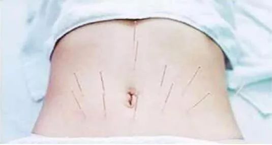 中医治疗产后肚子胀,产后腹胀的处理方法