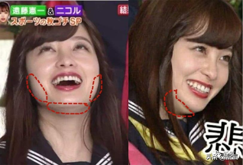 迷死氧亲身体验,我在日本吸掉了一桶脂肪和半张脸