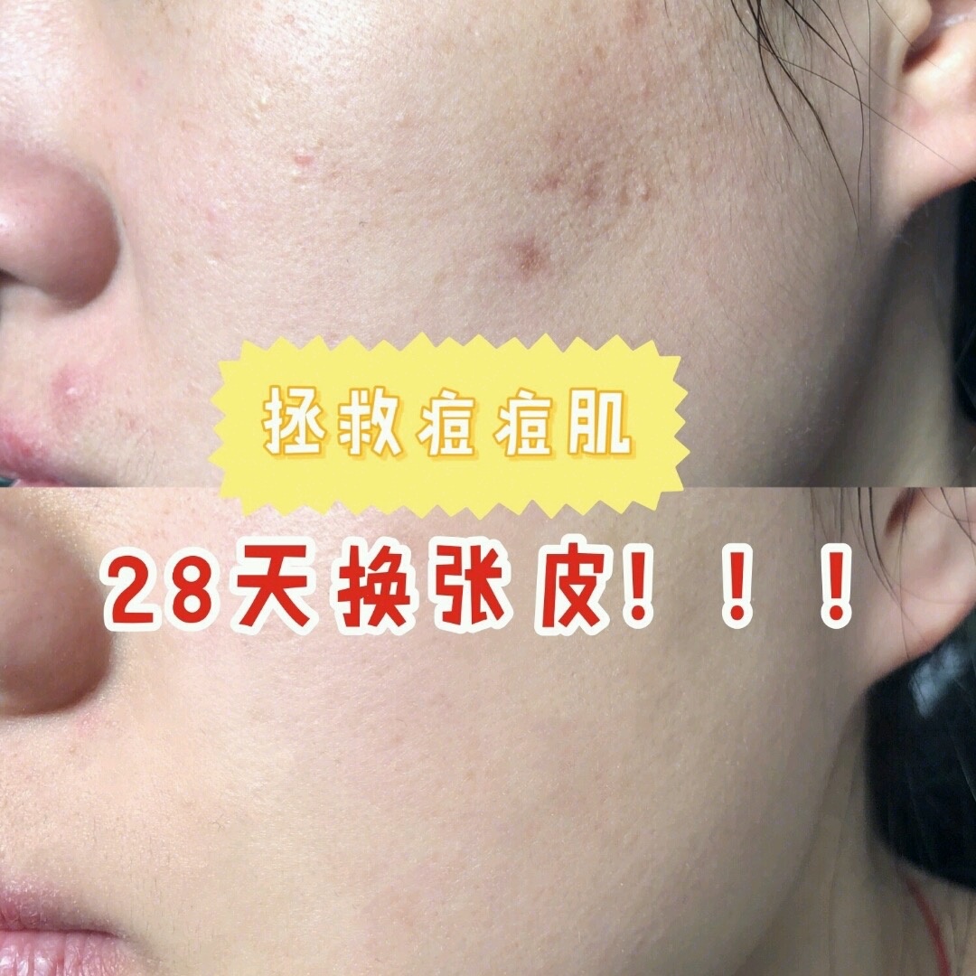 真实有效的几款祛痘印神器,祛痘印最有效的方法排名