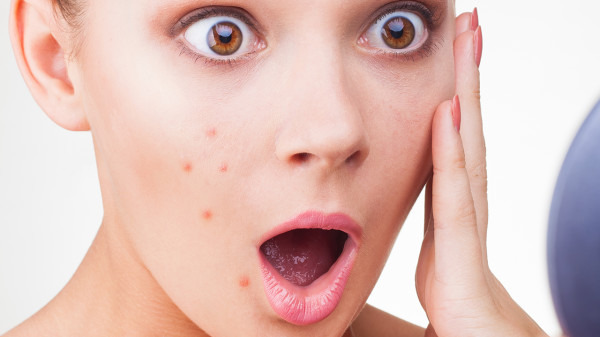 身上痘痘的种类,痘痘有哪些种类