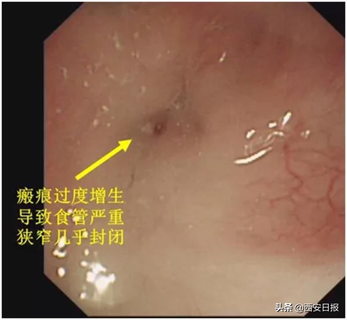 食道堵塞10毫米,食道狭窄1.5毫米可以扩张吗
