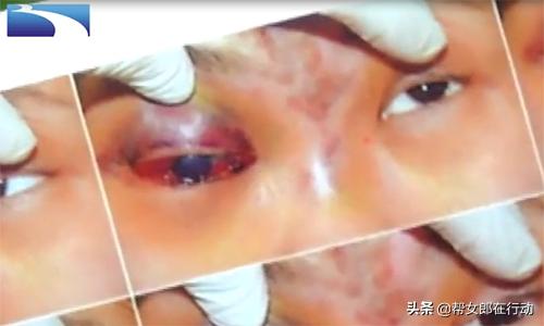整形失败眼睛失明,女子微整形导致失明