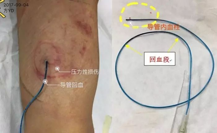 静脉留置针的护理论文,静脉留置针的操作及维护课件