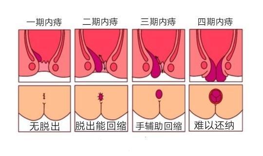 身体虚弱会导致痔疮发作,劳累能引起痔疮发作吗