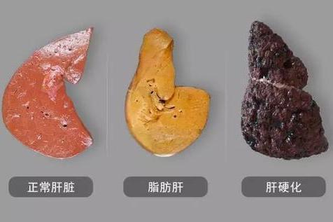 70岁人做肝胆结石手术能做吗,肝胆结石不做手术的后果是什么