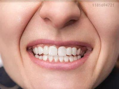 大连齿医生口腔科普想补牙？最好先了解一下这些补牙材料