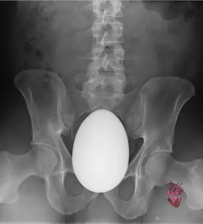 菊花塞足球，人体的极限到底有多大？