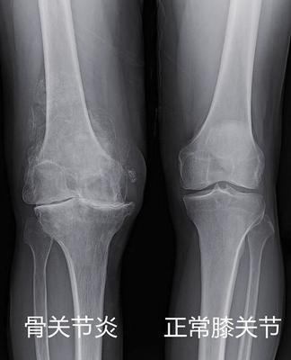 膝盖长了骨刺腿弯处疼怎么办,膝盖关节炎天冷了疼怎么办