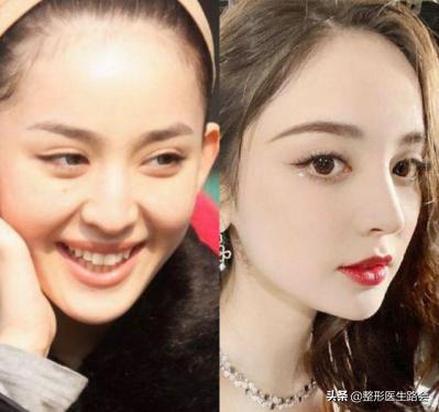 鼻翼缩小外切好吗,鼻翼缩小外切还是内切效果好