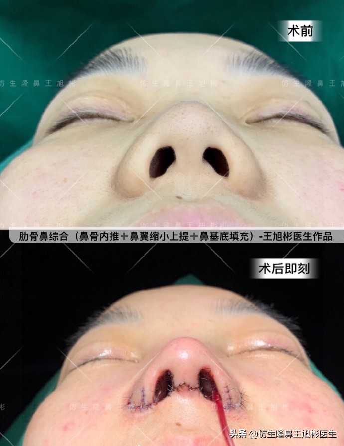 外切缩鼻翼的后遗症,外切鼻翼缩小会回弹吗