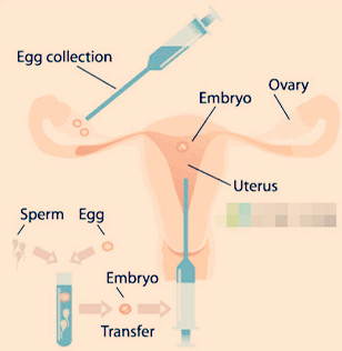 胚胎移植后该不该立马上厕所？