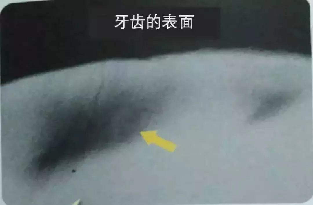 牙齿脱矿了如何补救,牙齿脱矿了怎么治