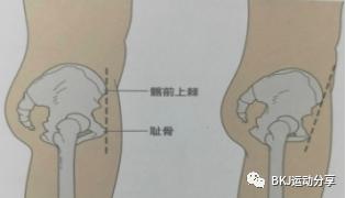 体态矫正之骨盆前倾