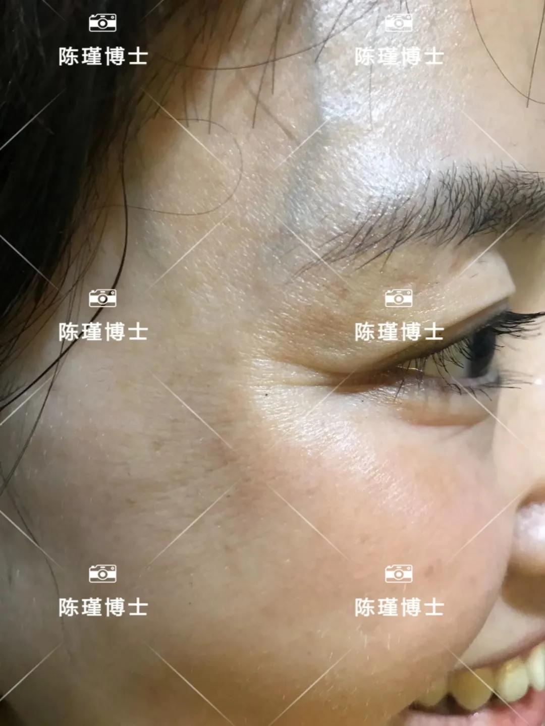 40岁女人皱纹越来越多显老态,40岁女人去皱纹最好的方法