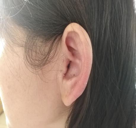 耳鼓膜修补手术方法有几种,爱耳日科普文章