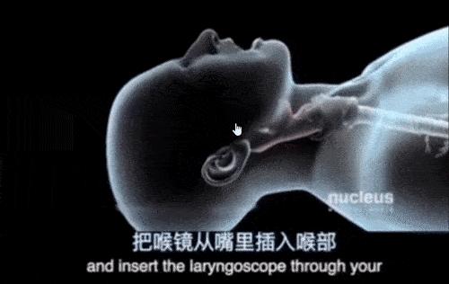 中国呼吸机国外供不应求,中国呼吸机现状