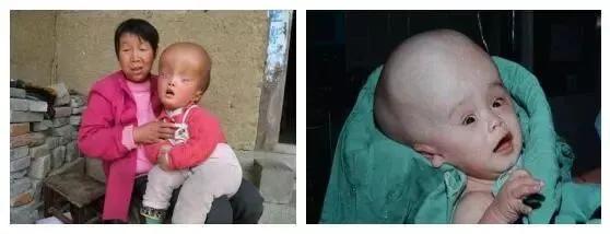 脑子里真的可以进水吗,一张图看懂脑积水