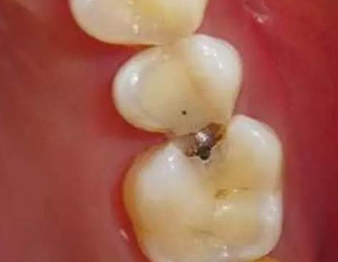 五岁小孩牙齿蛀了需要补吗,门牙边上的牙齿蛀了能补吗