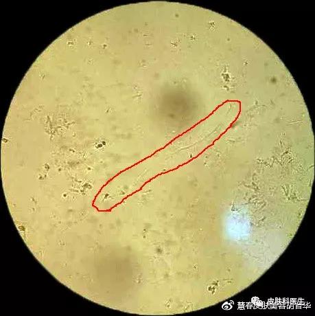 是湿疹或癣医生一眼就能辨出来吗,是不是体癣怎么检查