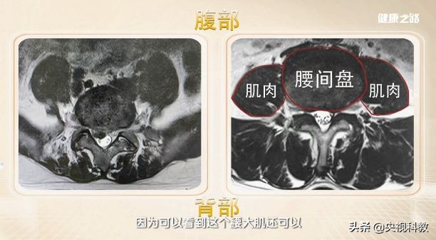 腰间盘突出怎么自我判定?怎么进行治疗?这篇文章告诉你