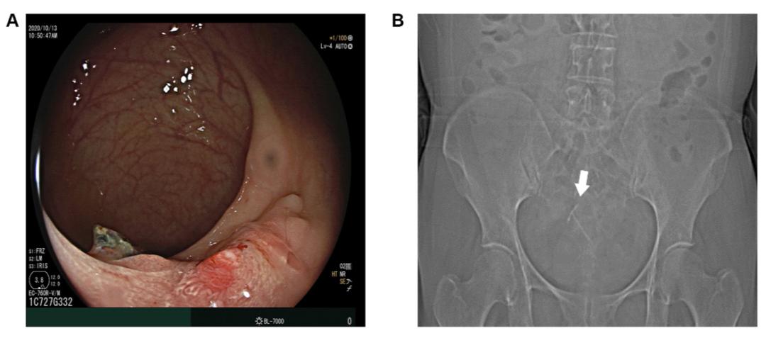 放了节育环三十年了现在取行吗,放了30多年的节育环还能怀孕吗