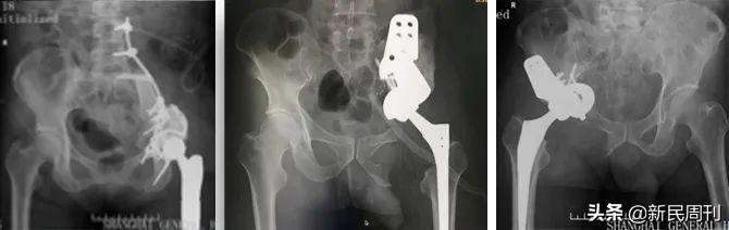 良医救治髓性白血病的发现者,良医救白血病专家