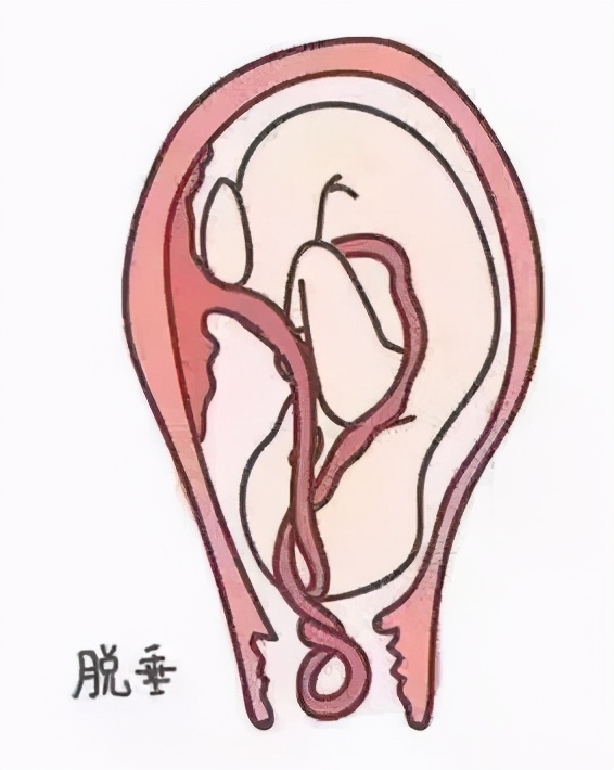 胎儿脐带脱垂命悬一线，医护协力争分夺秒，助准妈妈4分钟平安分娩
