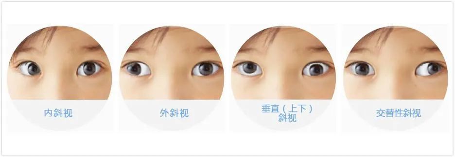 孩子总是侧头看东西？斜视治疗不及时可能失去视功能