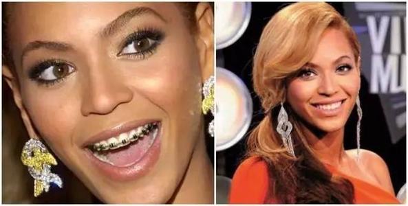 吴宣仪烤瓷牙怎么做,吴宣仪的整牙前