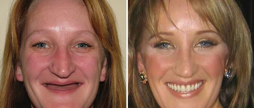 种植牙牙槽骨很薄怎么办,牙槽骨浅可以做种植牙吗