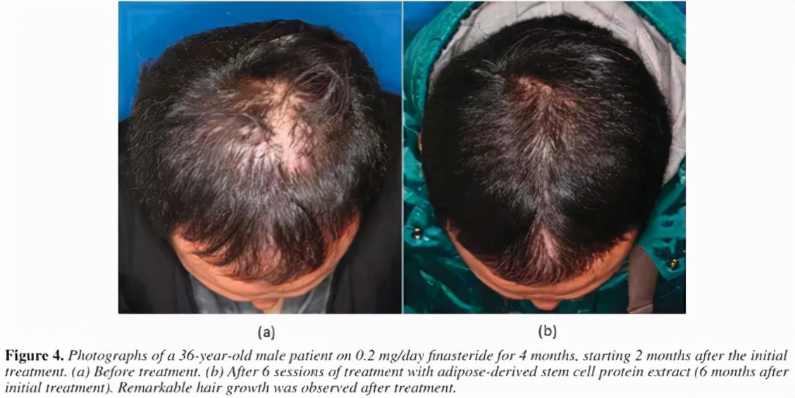 干细胞治疗秃头最新消息,干细胞治秃头