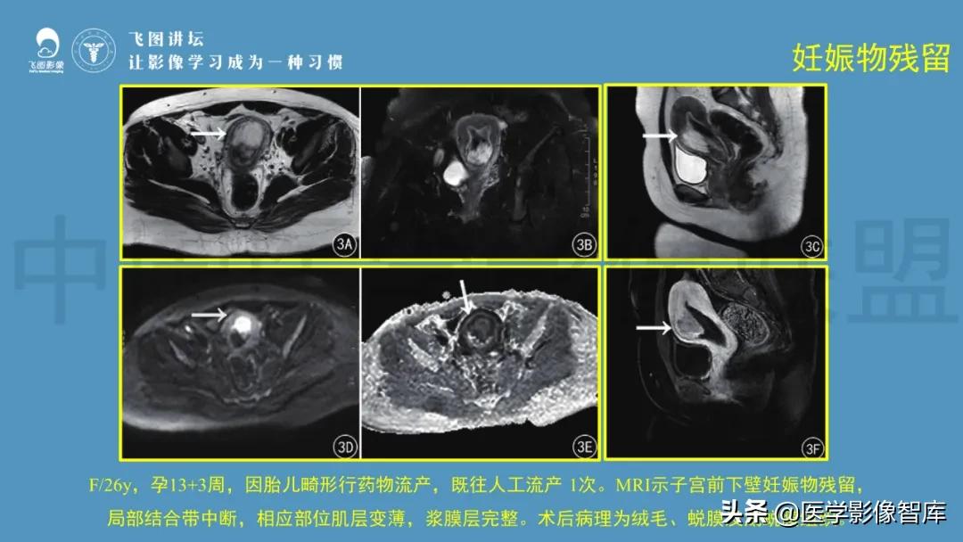 子宫解剖结构输卵管和卵巢位置,子宫附件ct影像学正常解剖表现