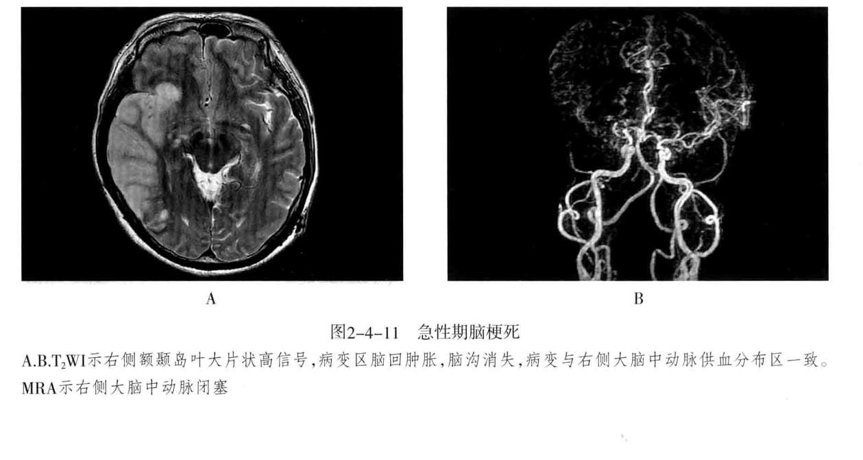 颅内血管轻度狭窄诊断标准,颅内血管先天变异影像