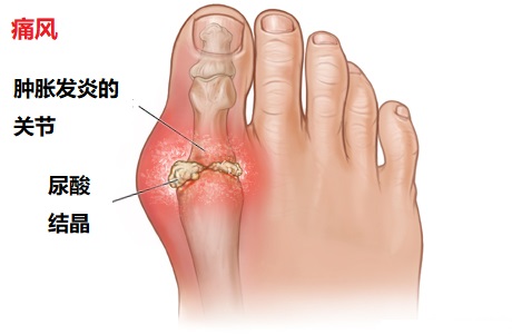 膝盖滑膜炎怎么回事,滑膜炎三大症状