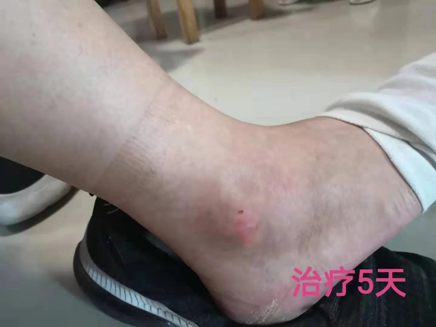 原始点痛风案例,痛风病人的案例分析