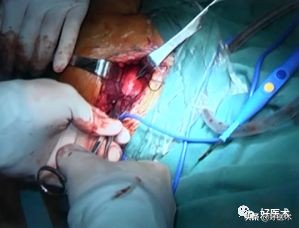 治疗肩锁关节脱位，有最好的方法吗？